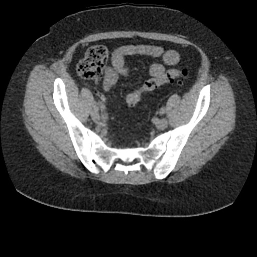 Acute cholecystitis and ureteric colic (Radiopaedia 42330-45444 Axial prone 85).jpg