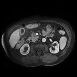 Acute cholecystitis complicated by pylephlebitis (Radiopaedia 65782-74915 Axial arterioportal phase T1 C+ fat sat 82).jpg