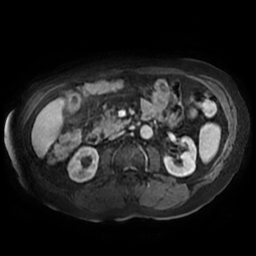 Acute cholecystitis complicated by pylephlebitis (Radiopaedia 65782-74915 Axial arterioportal phase T1 C+ fat sat 85).jpg