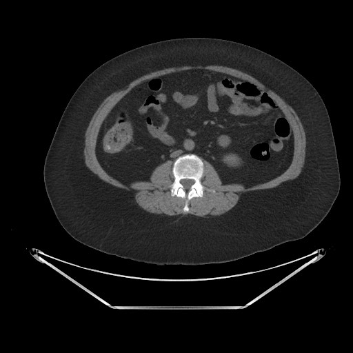 Acute cholecystitis with tensile fundus sign (Radiopaedia 71394-81723 Axial non-contrast 50).jpg