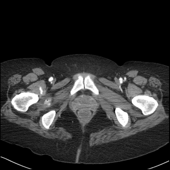Acute colonic hemorrhage in ulcerative colitis (Radiopaedia 77415-89538 Axial C+ arterial phase 138).jpg