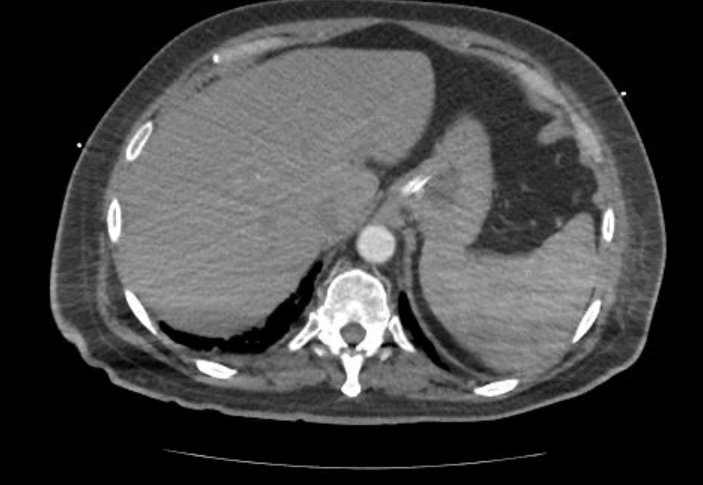 File:Acute cor pulmonale (ultrasound) (Radiopaedia 83508-98818 Axial C+ CTPA 78).jpg