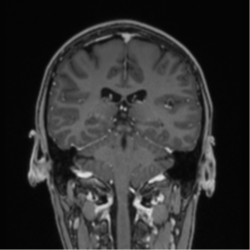 Acute disseminated encephalomyelitis (ADEM) (Radiopaedia 65319-74349 Coronal T1 C+ 14).png