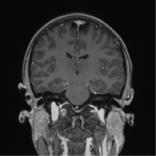 File:Acute disseminated encephalomyelitis (ADEM) (Radiopaedia 65319-74349 Coronal T1 C+ 21).png
