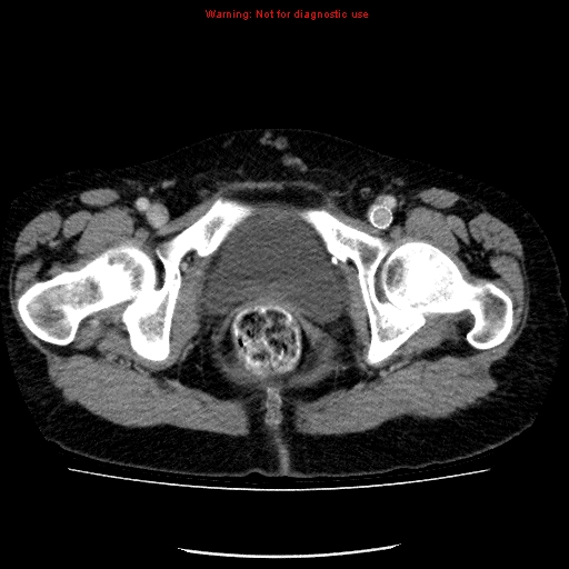 Acute gangrenous cholecystitis (Radiopaedia 10123-10661 Axial C+ portal venous phase 100).jpg