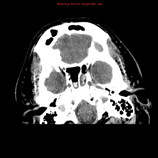 File:Acute hemorrhagic leukoencephalitis (Radiopaedia 14076-72275 Axial non-contrast 5).jpg