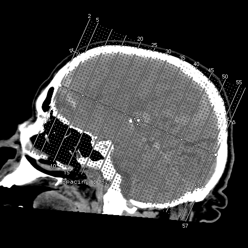 File:Acute hemorrhagic stroke (Radiopaedia 17507-17223 Coronal non-contrast 1).jpg