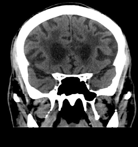 Acute left anterior cerebral artery territory infarction (Radiopaedia 51785-57578 Coronal non-contrast 21).jpg