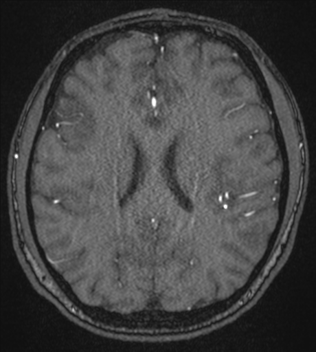 Acute left middle cerebral artery territory infarct with clot retrieval (Radiopaedia 47732-52433 Axial MRA 41).png