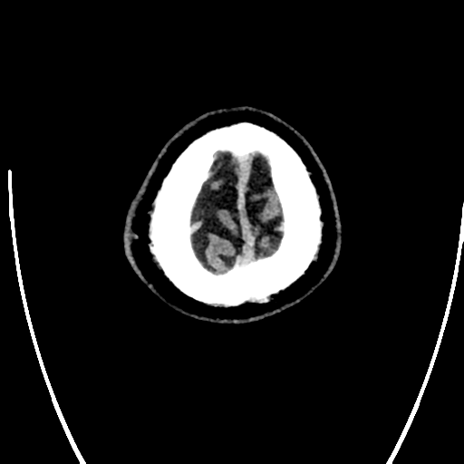 Acute left middle cerebral artery territory ischemic stroke (Radiopaedia 35688-37223 Axial non-contrast 85).png