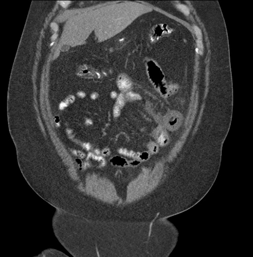 Acute mesenteric venous ischemia (Radiopaedia 46041-50383 Coronal C+ portal venous phase 22).jpg