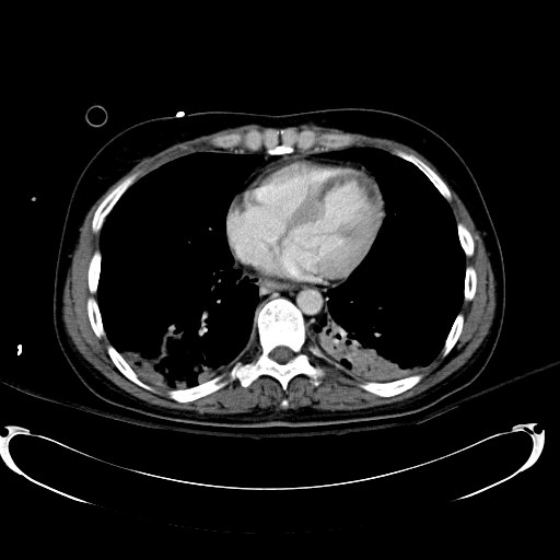 File:Acute myocardial infarction in CT (Radiopaedia 39947-42415 Axial C+ portal venous phase 3).jpg