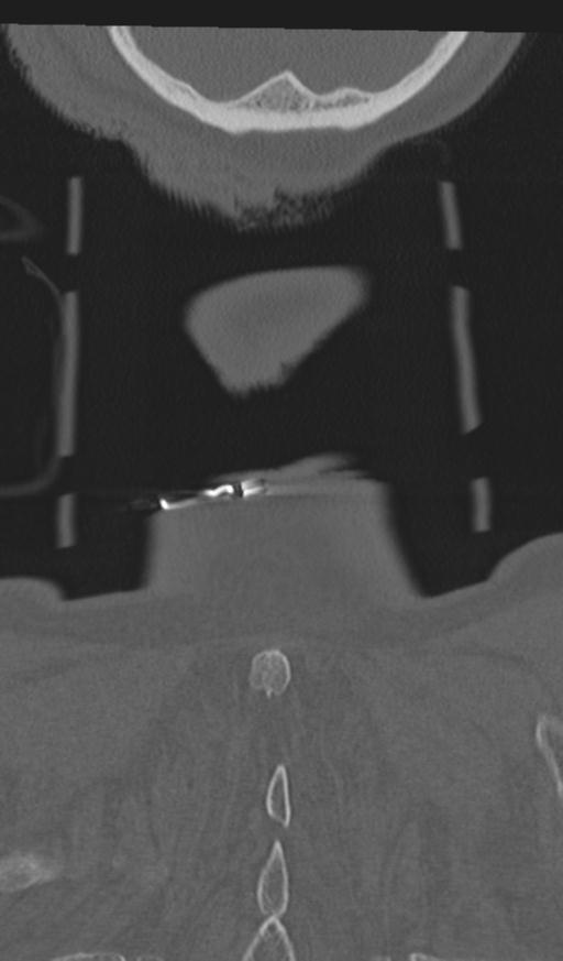 Acute on chronic subdural hematoma and thoracic vertebral injury in a multitrauma patient (Radiopaedia 31698-32619 Coronal bone window 73).jpg