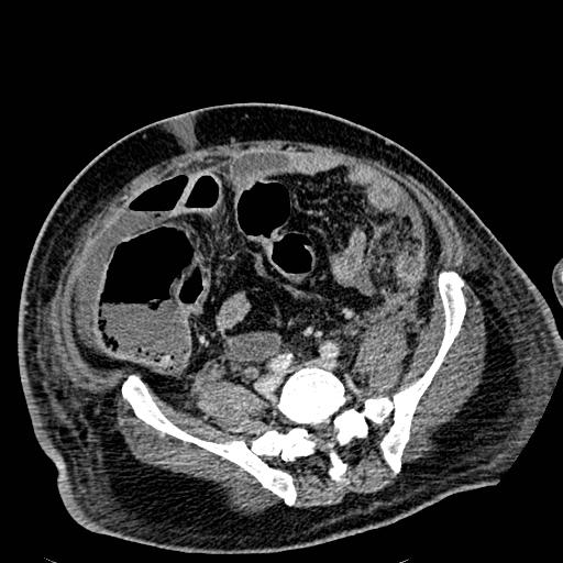 File:Acute pancreatic necrosis (Radiopaedia 13560-18501 Axial C+ portal venous phase 103).jpg