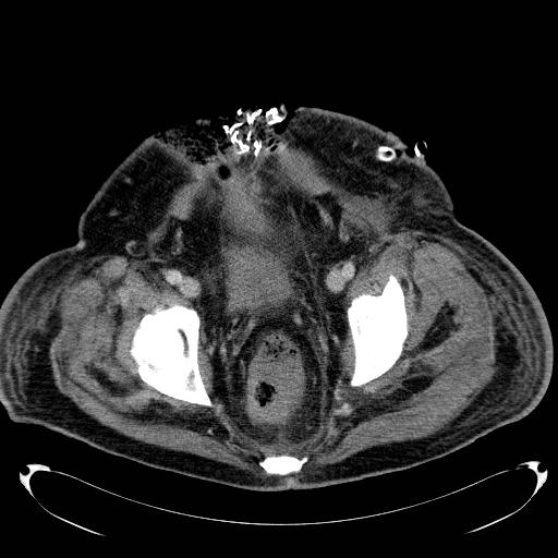 Acute pancreatic necrosis (Radiopaedia 13560-18503 Axial C+ portal venous phase 75).jpg