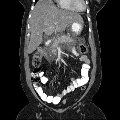 File:Acute pancreatitis (Radiopaedia 20829-20744 Coronal C+ portal venous phase 20).jpg