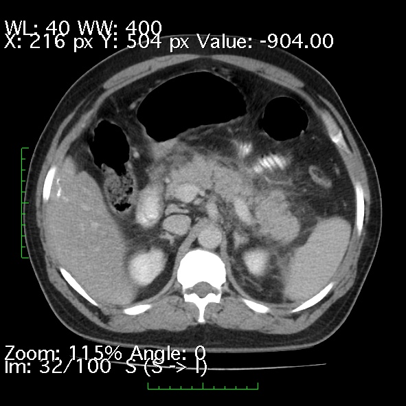 Acute pancreatitis (Radiopaedia 34043-35276 Axial C+ portal venous phase 32).jpg