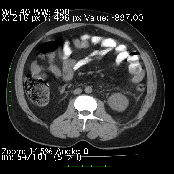 Acute pancreatitis (Radiopaedia 34043-35276 Axial non-contrast 54).jpg