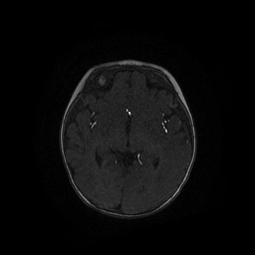 File:Acute phase of hemiconvulsion-hemiplegia epilepsy syndrome (Radiopaedia 29309-29745 Axial TOF angiography 65).jpg