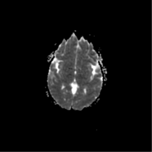 File:Acute pontine infarct from vertebral artery dissection (Radiopaedia 34111-35370 Axial ADC 11).png