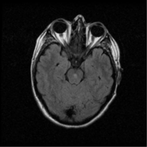 File:Acute pontine infarct from vertebral artery dissection (Radiopaedia 34111-35370 Axial FLAIR 7).png