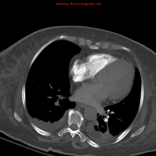 Acute pulmonary embolism (Radiopaedia 13286-13289 Axial C+ CTPA 42).jpg