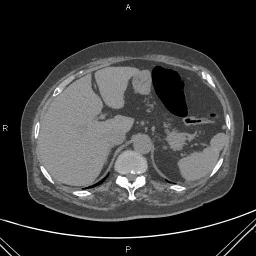 Acute renal artery occlusion (Radiopaedia 86586-102682 Axial non-contrast 15).jpg