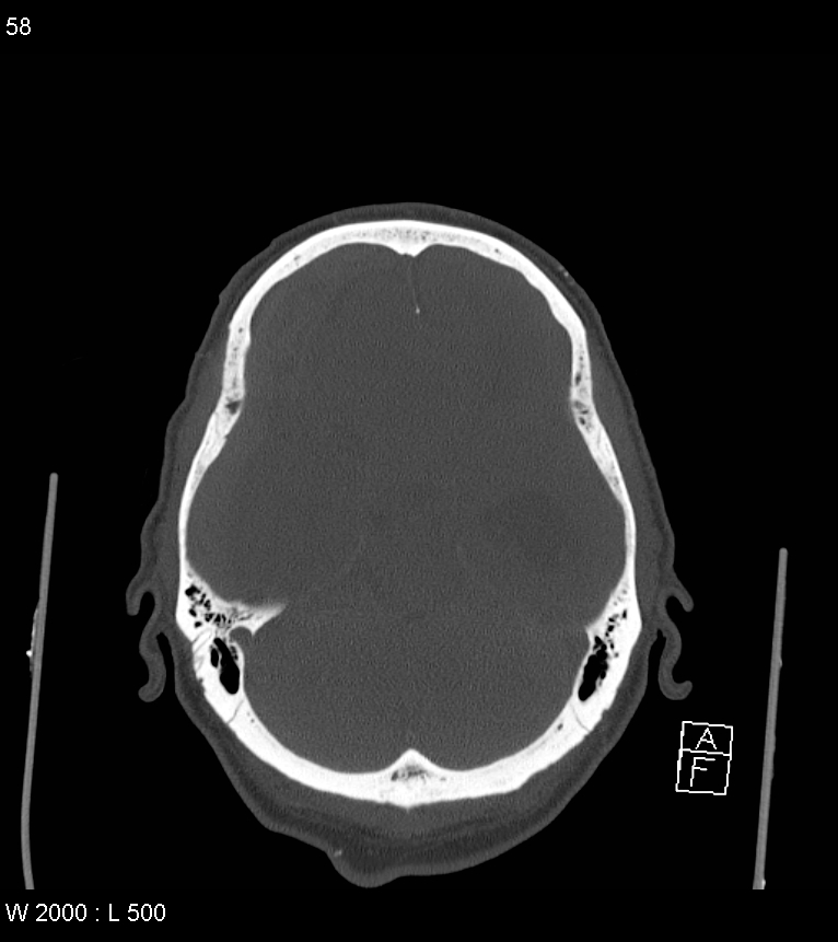 Acute subdural hematoma with myelofibrosis (Radiopaedia 52582-58494 Axial bone window 29).jpg