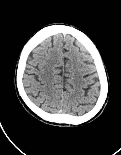Acute superior cerebellar artery territory infarct (Radiopaedia 84104-99359 Axial non-contrast 21).jpg