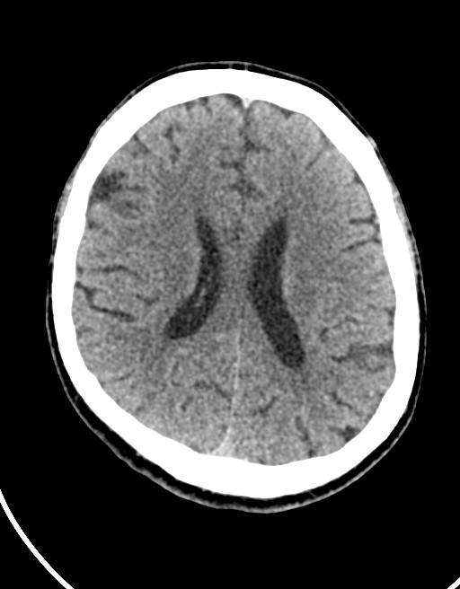 Acute superior cerebellar artery territory infarct (Radiopaedia 84104-99359 Axial non-contrast 29).jpg