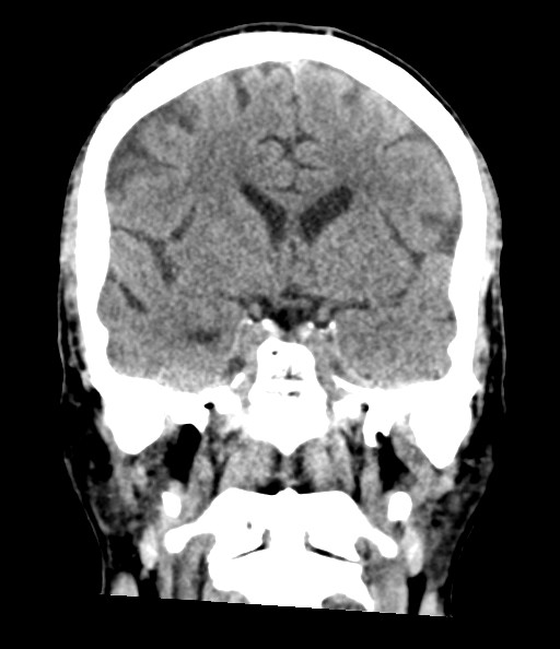 File:Acute superior cerebellar artery territory infarct (Radiopaedia 84104-99359 Coronal non-contrast 45).jpg