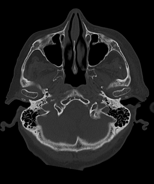 Acute traumatic subdural hematoma (Radiopaedia 82921-97257 Axial bone window 90).jpg