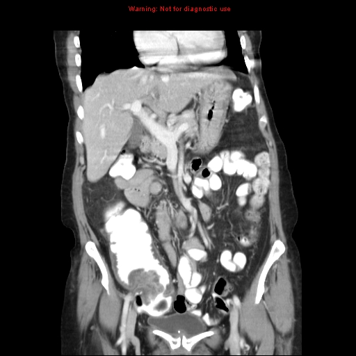 File:Adenocarcinoma of the colon (Radiopaedia 8191-9039 Coronal liver window 18).jpg