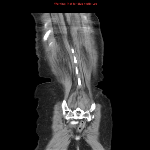 File:Adenocarcinoma of the colon (Radiopaedia 8191-9039 Coronal liver window 43).jpg