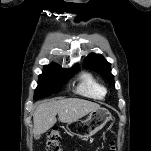 Adenocarcinoma of the lung (Radiopaedia 59871-67325 Coronal C+ arterial phase 9).jpg