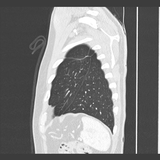 Adenocarcinoma of the lung (Radiopaedia 59871-67325 Sagittal lung window 88).jpg