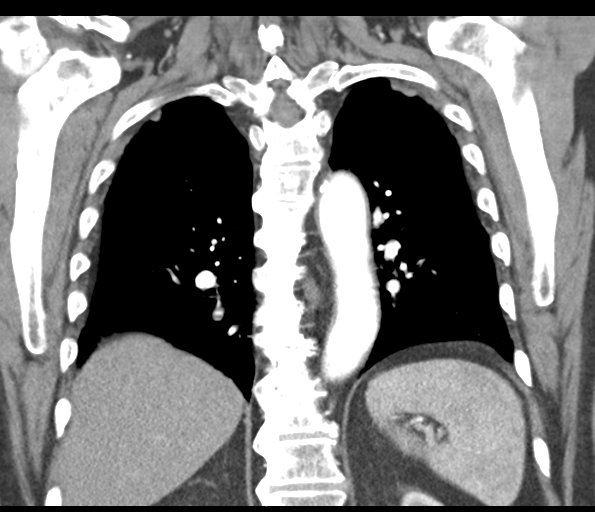File:Adenocarcioma of rectum- T1 lesion (Radiopaedia 36921-38547 Coronal C+ arterial phase 44).png