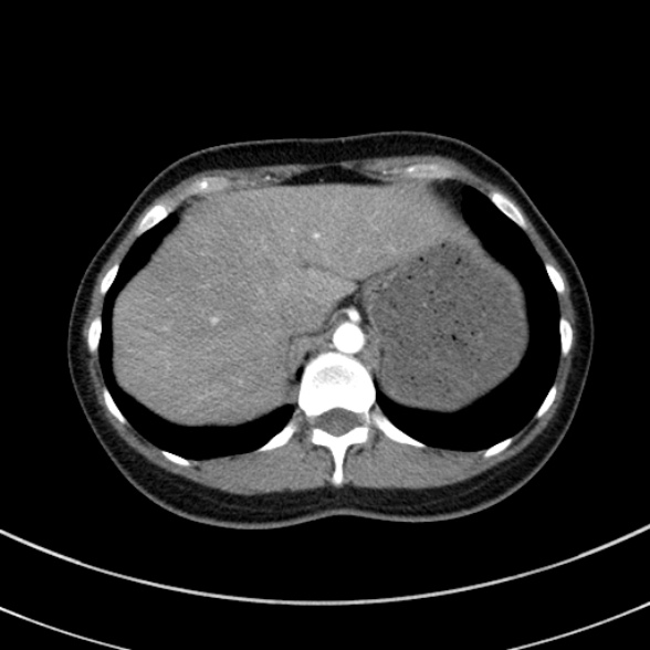 Adenocystic carcinoma of the trachea (Radiopaedia 47677-52525 Axial C+ arterial phase 74).jpg