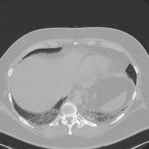 File:Adenoid cystic carcinoma of the trachea (Radiopaedia 49042-54137 Axial lung window 284).jpg