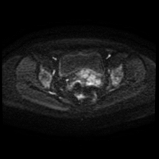 Adenoma malignum of cervix (Radiopaedia 66441-75705 Axial DWI 89).jpg
