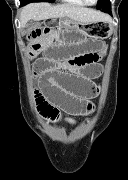 Adhesional small bowel obstruction (Radiopaedia 48397-53305 Coronal C+ portal venous phase 78).jpg