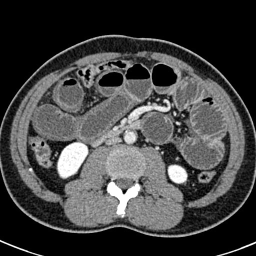 Adhesional small bowel obstruction (Radiopaedia 58900-66131 Axial C+ portal venous phase 25).jpg