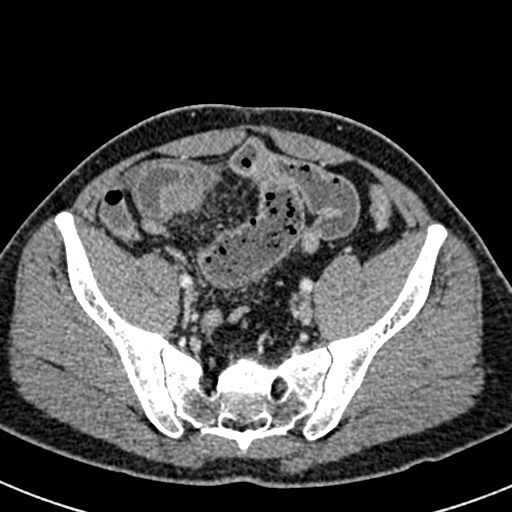 File:Adhesional small bowel obstruction (Radiopaedia 58900-66131 Axial C+ portal venous phase 42).jpg
