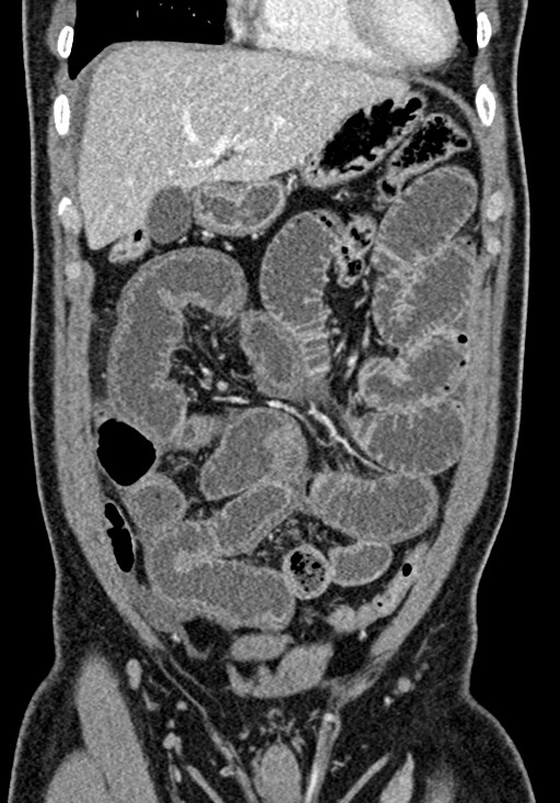 Adhesional small bowel obstruction (Radiopaedia 58900-66131 Coronal C+ portal venous phase 98).jpg