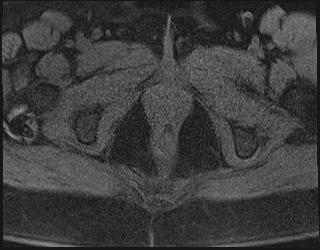 File:Adnexal multilocular cyst (O-RADS US 3. O-RADS MRI 3) (Radiopaedia 87426-103754 Axial 218).jpeg