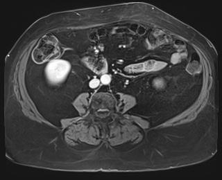 File:Adrenal cortical carcinoma (Radiopaedia 64017-72770 J 62).jpg