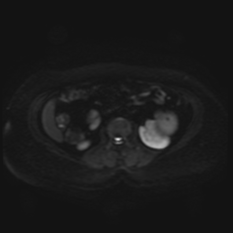 Adrenal cortical carcinoma (Radiopaedia 70906-81116 Axial DWI 19).jpg