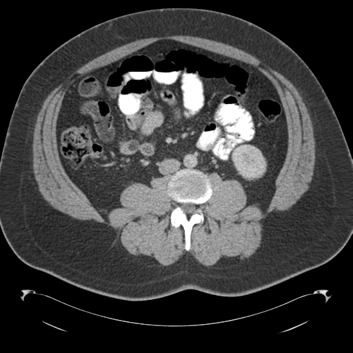 File:Adrenal cyst (Radiopaedia 45625-49776 Axial C+ portal venous phase 53).png