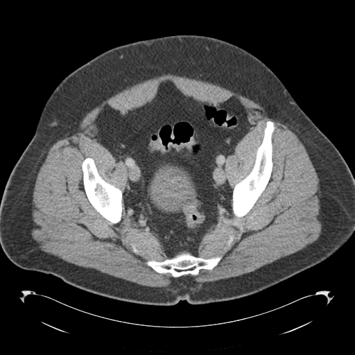 File:Adrenal cyst (Radiopaedia 45625-49776 Axial C+ portal venous phase 83).png