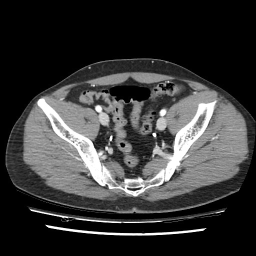 Adrenal gland trauma (Radiopaedia 81351-95078 Axial Dual bolus trauma C+ 107).jpg